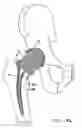 Fig. 10 - Knee prosthesis having a deformable articulation surface