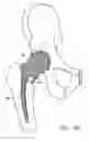 Fig. 12 - Knee prosthesis having a deformable articulation surface