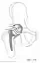 Fig. 19 - Knee prosthesis having a deformable articulation surface
