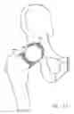 Fig. 20 - Knee prosthesis having a deformable articulation surface