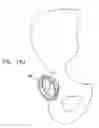 Fig. 26 - Knee prosthesis having a deformable articulation surface