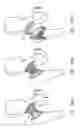 Fig. 28 - Knee prosthesis having a deformable articulation surface