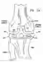 Fig. 32 - Knee prosthesis having a deformable articulation surface