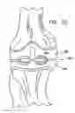Fig. 40 - Knee prosthesis having a deformable articulation surface
