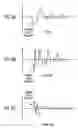 Fig. 09 - Electronic percussion instrument, system and method with rim shot detection