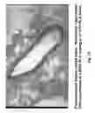 Fig. 11 - Soft tissue implants and anti-scarring agents