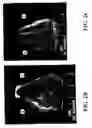 Fig. 04 - Transplantable particulate bone composition having high osteoinductive capacity and methods for making and using same
