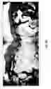 Fig. 80 - Adipose-derived stem cells and lattices