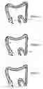 Fig. 04 - Magnetically guided colonoscope