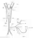 Fig. 01 - Method and apparatus for treating a carotid artery