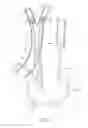 Fig. 02 - Method and apparatus for treating a carotid artery