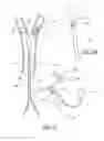 Fig. 03 - Method and apparatus for treating a carotid artery