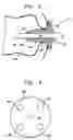 Fig. 03 - Pressure-propelled system for body lumen