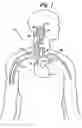 Fig. 02 - Baroreflex activation for pain control, sedation and sleep