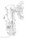 Fig. 04 - Baroreflex activation for pain control, sedation and sleep