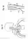 Fig. 06 - Baroreflex activation for pain control, sedation and sleep