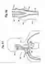 Fig. 09 - Baroreflex activation for pain control, sedation and sleep
