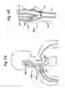 Fig. 10 - Baroreflex activation for pain control, sedation and sleep