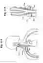 Fig. 12 - Baroreflex activation for pain control, sedation and sleep