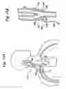 Fig. 13 - Baroreflex activation for pain control, sedation and sleep