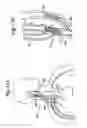 Fig. 16 - Baroreflex activation for pain control, sedation and sleep