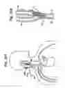 Fig. 17 - Baroreflex activation for pain control, sedation and sleep