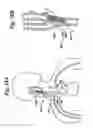 Fig. 19 - Baroreflex activation for pain control, sedation and sleep