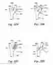 Fig. 23 - Baroreflex activation for pain control, sedation and sleep