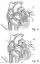 Fig. 07 - System for terminating heart arrhythmia using electrical shocks delivered through a set of internal and external electrodes configurable to a multitude of shock configurations by selecting the shock vector(s) on a control device that also provides 