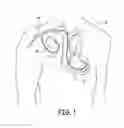 Fig. 02 - Method for reducing implantable defibrillator volume