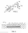 Fig. 03 - Heating method for tissue contraction