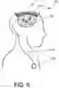 Fig. 11 - Articulated neural electrode assembly