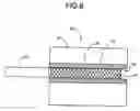 Fig. 09 - Stent reducing system and device