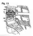 Fig. 07 - Method, system and apparatus for interbody fusion