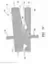 Fig. 09 - Laterally insertable artificial vertebral disk replacement implant with translating pivot point