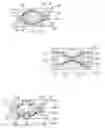 Fig. 03 - Artificial intervertebral disc