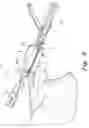 Fig. 09 - Acromioclavicular joint prosthesis