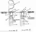 Fig. 03 - Modular phrosthesis assembly including tapered adjustments