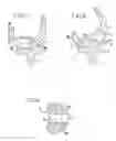 Fig. 03 - Complete knee prosthesis