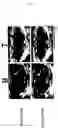 Fig. 07 - Desmin gene having novel point mutation causative of dilated cardiomyopathy