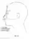 Fig. 45 - Respiratory mask assembly with magnetic coupling to headgear assembly