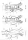 Fig. 07 - Bodily lumen closure apparatus and method