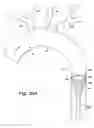 Fig. 30 - Cerebral perfusion augmentation