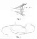 Fig. 04 - Intraocular pressure sensor