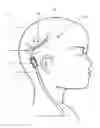 Fig. 01 - Multi-catheter insertion device and method