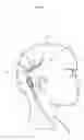 Fig. 02 - Multi-catheter insertion device and method