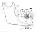 Fig. 05 - Periosteal distraction bone growth