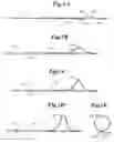 Fig. 02 - Endovascular guidewire filter and methods of use
