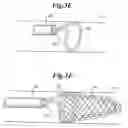 Fig. 06 - Endovascular guidewire filter and methods of use