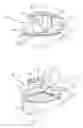 Fig. 04 - Disposable eyelid retractor apparatus